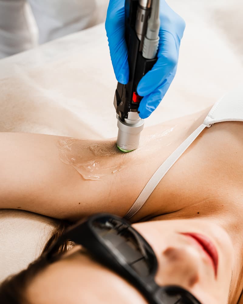 Épilation laser