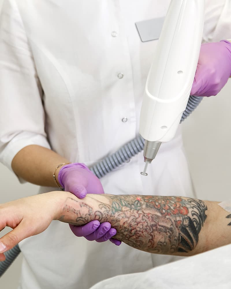 Détatouage